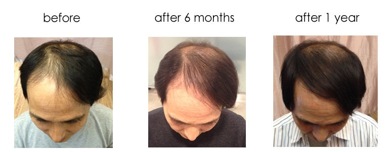 Testimonials by Mr. M "I thought I would be completely bald in the future, but I tried using it as my last wish."